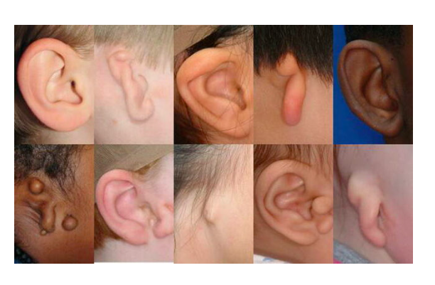 Image showing Congenital Ear Deformities